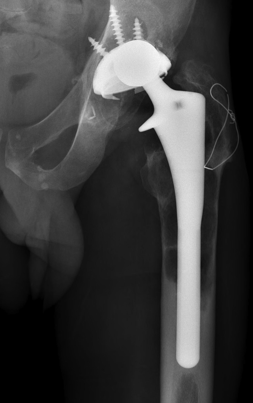 Type 3 A Femur